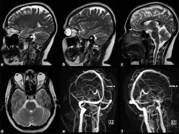 Кт сосудов головы и шеи. Кт (компьютерная томография) сосудов головного мозга. Мрт головного мозга с ангиографией. Васкулит головного мозга мрт. Магнитно резонансные томограммы головного мозга.