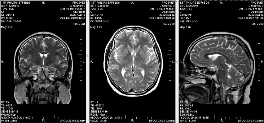 Как выглядят снимки МРТ головного мозга с контрастом