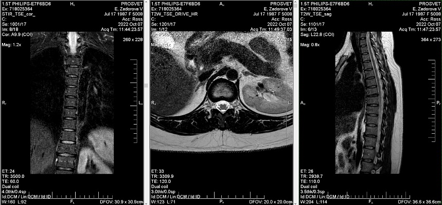 Как выглядят снимки МРТ грудного отдела позвоночника