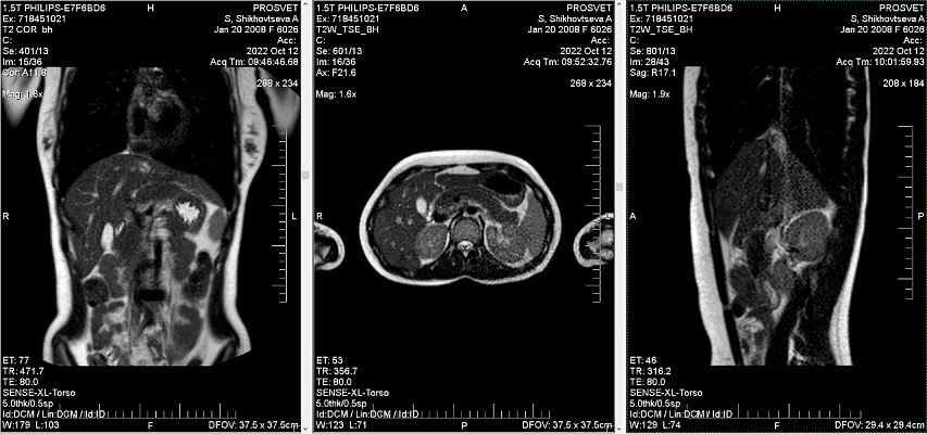 Как выглядят снимки МРТ брюшной полости