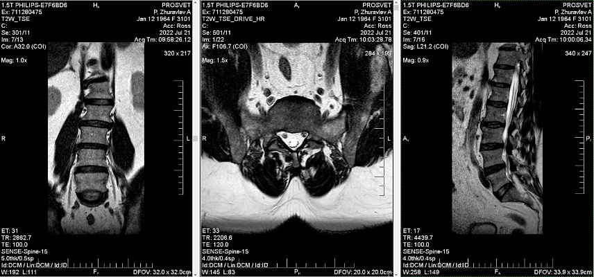 Как выглядят снимки МРТ пояснично-крестцового отдела
