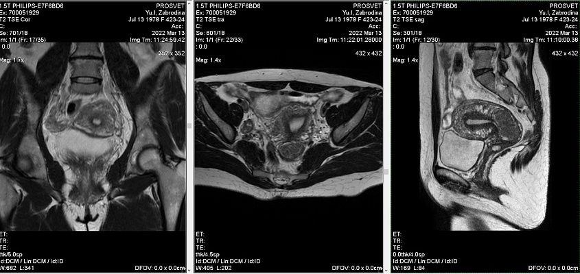 Как выглядят снимки МРТ органов малого таза
