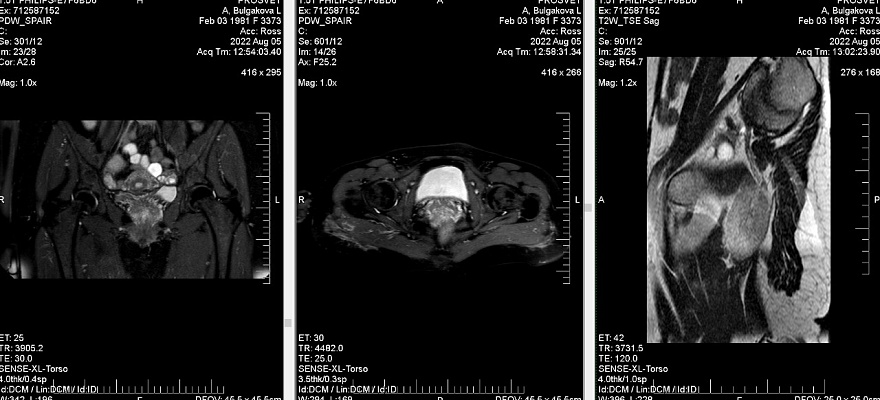 Как выглядят снимки МРТ тазобедренного сустава