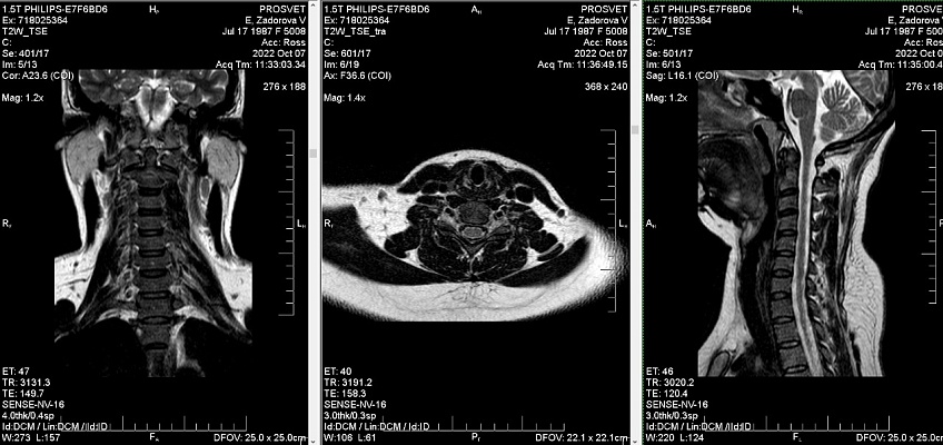 Как выглядят снимки МРТ шейного отдела позвоночника