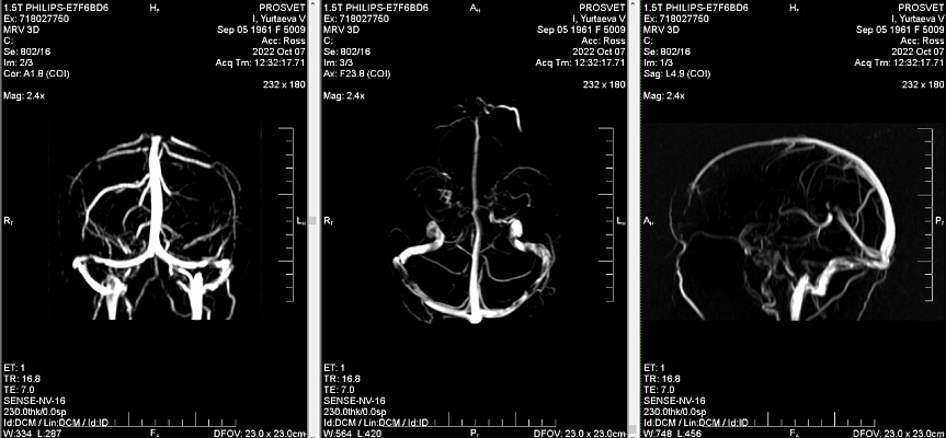 Как выглядят снимки МРТ сосудов головного мозга