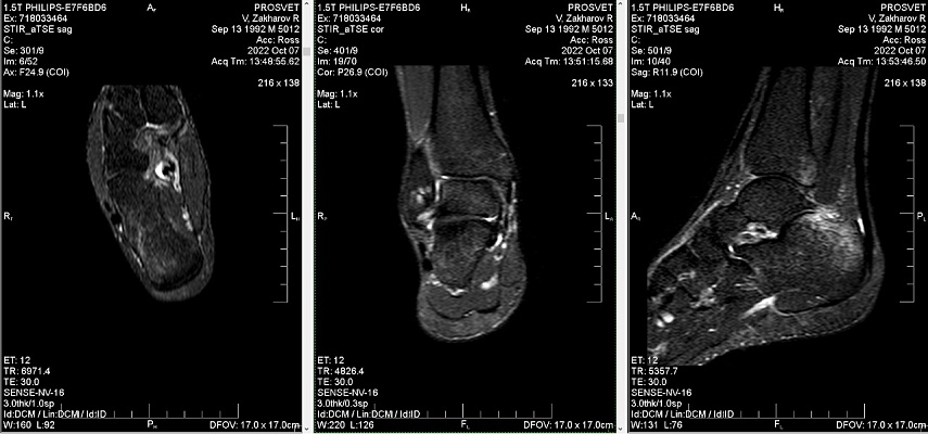 Как выглядят снимки МРТ голеностопного сустава